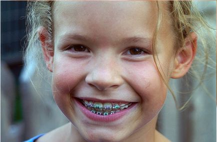 Дитяча стоматологія, ортодонтія установка брекетів, брекети лінгвальні