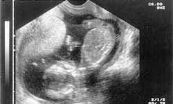 Este ultrasunetele fetale cu adevarat sigure?