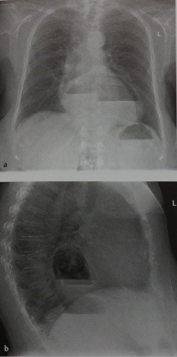Rekeszsérv sérvek és hiatus hernia (rekeszsérv tünetek) Rekeszsérv sérvek és hiatus hernia