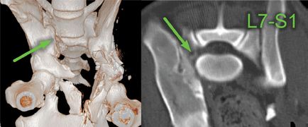 Diagnosticul sindromului radicular lombosacral