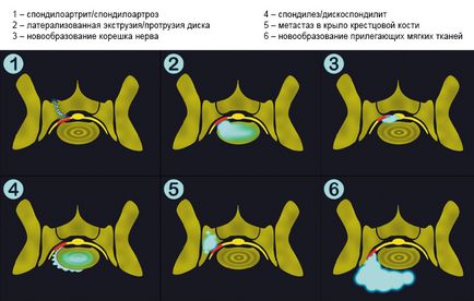 Diagnosticul sindromului radicular lombosacral