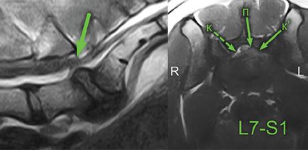 Diagnosticul sindromului radicular lombosacral