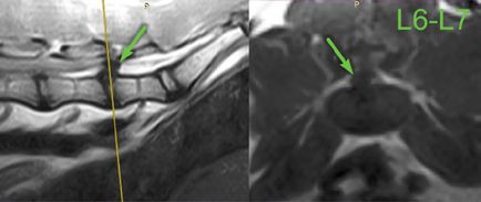 Diagnosticul sindromului radicular lombosacral