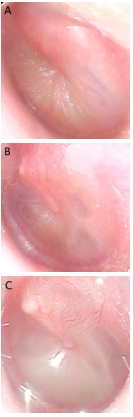 Диагностика на възпаление на средното ухо - отоскопия и отстраняване на ушна кал