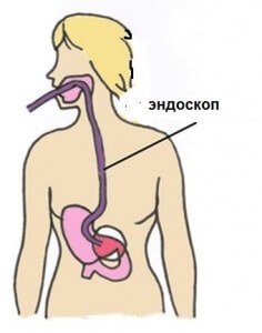 Diagnózis a Helicobacter pylori gasztroszkópia biopsziás Izraelben, Ichilov