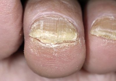 nail gombák on iodinol kezelés