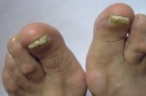 nail ábra foot kezelés lakk gyógymód köröm gomba által népi jogorvoslati gyorsan