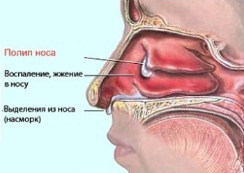 Доброякісні пухлини порожнини носа