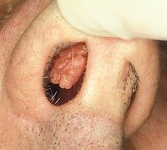 Доброякісні пухлини порожнини носа причини, симптоми, діагностика та лікування