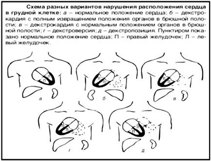 ЕКГ при декстрокардіі