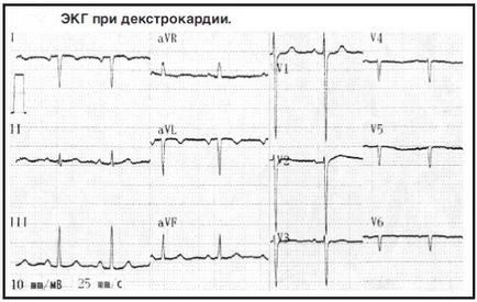 ЕКГ при декстрокардіі