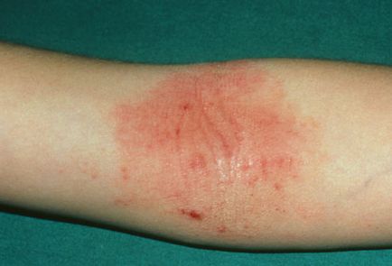 Eczemă pe mâinile cauzelor, tratamentul diferitelor tipuri de boli