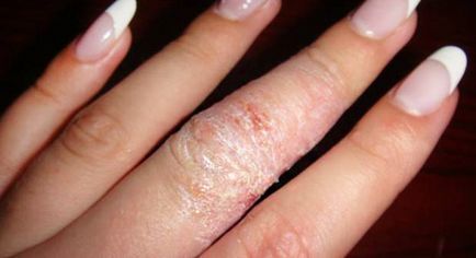 Eczemă pe mâinile cauzelor, tratamentul diferitelor tipuri de boli