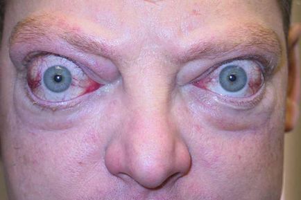 Exophthalmos - descriere, cauze, tratament