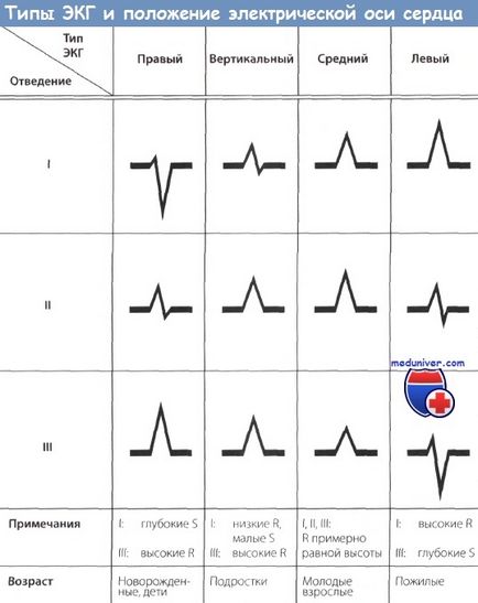 Electrocardiograma cu dextrocardie și dextroeruzie