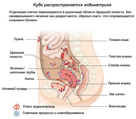 Ендометріоз, причини і симптоми ендометріозу, лікування, популярна медицина