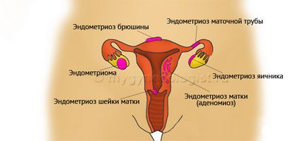 Endometriózis petefészek, petevezeték és más szervekben én nőgyógyász (egyéb) Az endometriózis a petefészkek, petevezetők és más szervek, a nőgyógyász