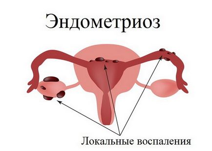 Endometrita și endometrioza Care este diferența, ceea ce este diferit