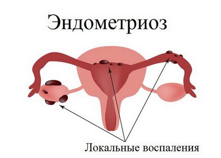 Endometriosis, endometritis, és a különbség a különbség (a különbség) Endometritis és endometriosis Mi a különbség, a különbség