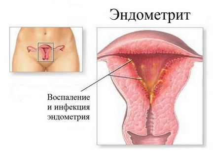 Endometrita și endometrioza Care este diferența, ceea ce este diferit