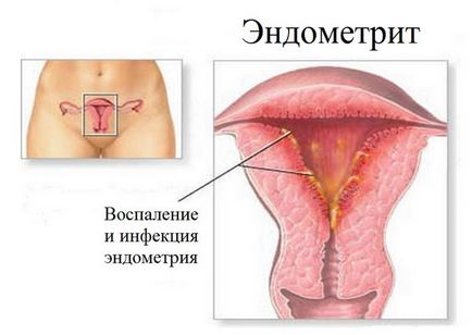 Ендометрит і ендометріоз в чому різниця, чим відрізняється