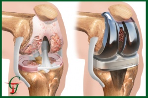 Endoproteticele articulației genunchiului cu necroză aseptică a condylelor