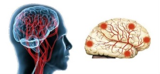 Енцефалопатія головного мозку причини, симптоми і лікування