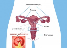 Eroziunea cervicală, cauzele debutului, simptomele și tratamentul