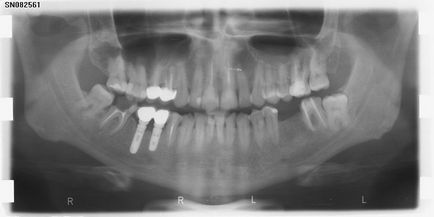 Еволюція російської системи стоматологічних імплантатів лико