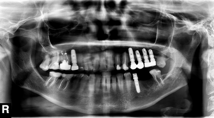 Evoluția sistemului rusesc de implanturi dentare liko