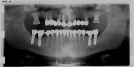 Еволюція російської системи стоматологічних імплантатів лико