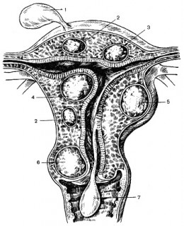 Фіброма, фіброміома матки - що це таке, ознаки, симптоми, лікування, операція