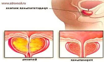 Фізіоаппарати, які пропонуються сучасний споживач для лікування простатиту