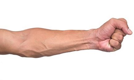 Venetele de flebită la tratamentul brațului