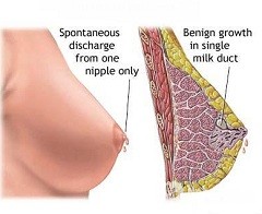 Galactorie - cauze, simptome, diagnostic, metode de tratament