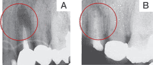 Гальванофорез - антисептична обробка всіх микроканалов зуба - стоматологія Ютас