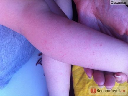 Гель-бальзам після укусів mosquitall комах, опіків - «викликає алергію! (Фото шкіри після