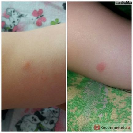 Гель-бальзам після укусів mosquitall комах, опіків - «mosquitall, тому що закусали! алергія