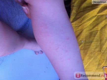 Гель-бальзам після укусів mosquitall комах, опіків - «викликає алергію! (Фото шкіри після