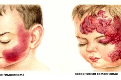 Гемангіома на губі лікування