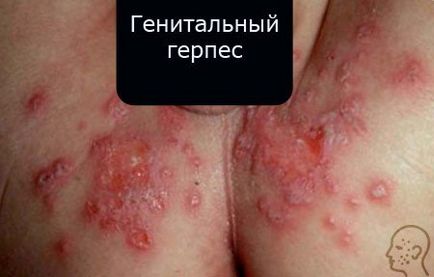 Herpes - care sunt cauzele, simptomele și tratamentul