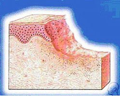 Herpes - care sunt cauzele, simptomele și tratamentul