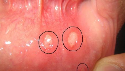 Herpesz a belsejében a száj kezelésére
