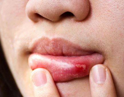 Herpesul din interiorul buzei cauzează și tratamentul herpesului în interiorul buzei