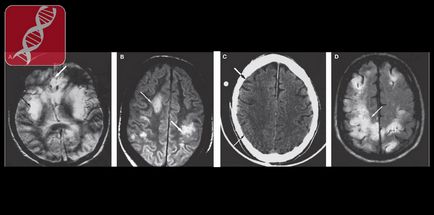 Infecții herpetice ale sistemului nervos, neurologie