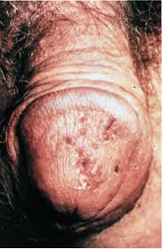 Herpetic (herpes) uretrita