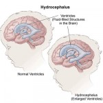 Hidrocefalul creierului, secretele medicinei populare