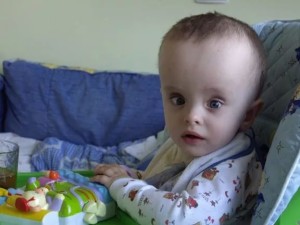 Vízfejével szindróma csecsemők tünetek és a kezelés hatásainak