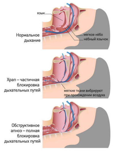 Gimnastica de la sforăitul complex de exerciții respiratorii strelnikovoj, precum și în ceea ce avantajul sau beneficiul lor și