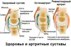 Glucozamina și condroitina - un instrument eficient pentru prevenirea și tratamentul bolilor degenerative